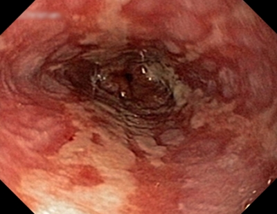 Image result for Esophagitis