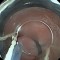 Sequence 4: excision of the lesion using multiple-band ligation