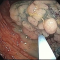 Sequence 5 — continuing the excision and removing small residual pieces of adenoma