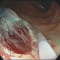 Sequence 6 — inspection of the resection margins and closure of the resection site using clips