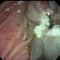 Sequence 5: Probing of the pancreatic duct after papillectomy.