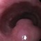 Sequence 1 — esophagogastroduodenoscopy (EGD) with an incidental finding of a submucosal tumor (SMT) in the mid-esophagus