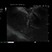Sequenz 2 – Endosonographisch gesteuerte Punktion der Gallenblase