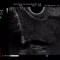 Sequence 2 — endosonographic transgastric puncture of the bile ducts