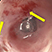 Sequence 3 - example case of peptic esophageal stenosis