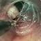 Sequence 5 — endoscopic resection of the SMT using the tunnel technique: part 3, capsule-protecting tumor dissection