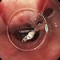 Sequenz 8 - Endoskopische Resektion des SMT in Tunneltechnik – Teil 6 Resektionshöhle und Verschluss des Kanals