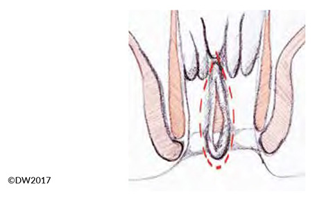 Thrombose anal