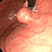 Sequence 1 - Endoscopic and endoscopic ultrasound (EUS) depiction of a submucosal gastric tumor