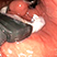 Sequence 2 - Suturing the gastric wall using the GERD-X suturing device